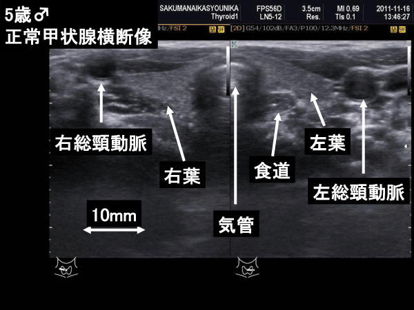 甲状腺図