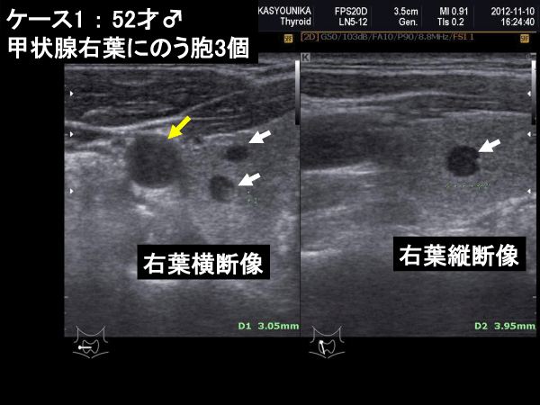 甲状腺図