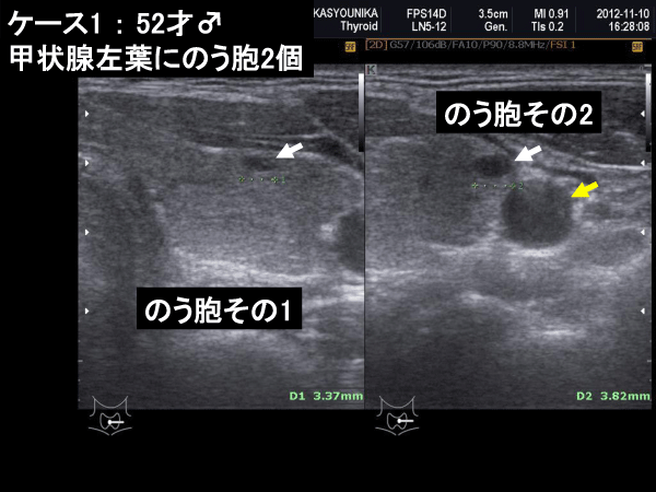 甲状腺図