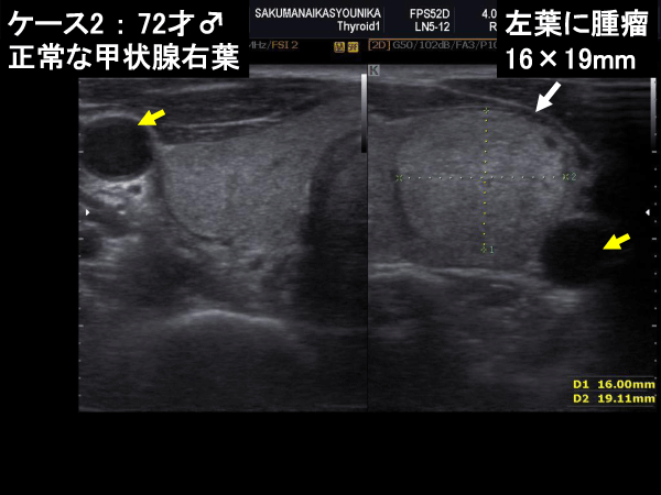 甲状腺図