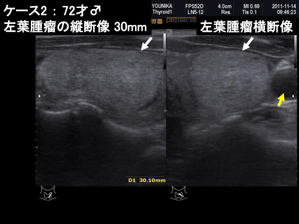 甲状腺図